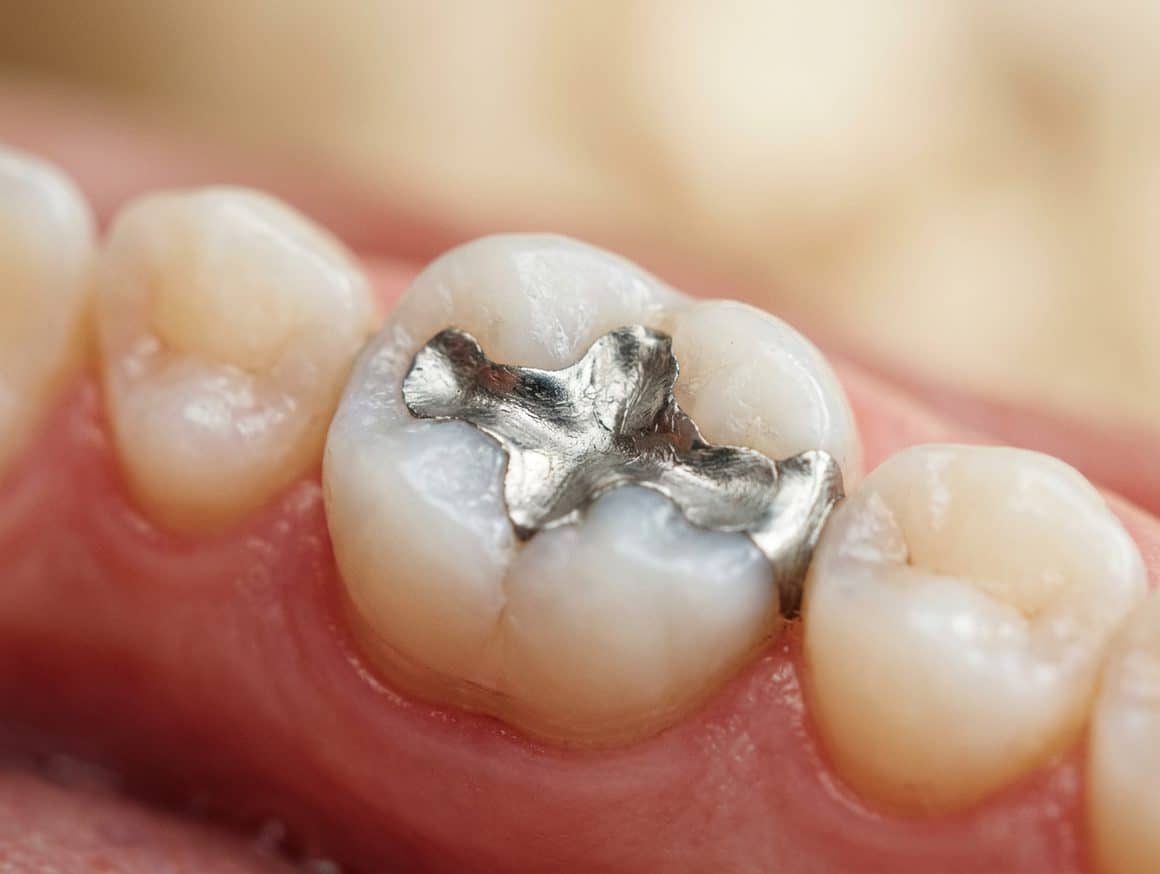 Amalgaamvulling behandeling