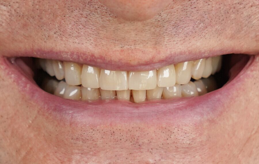 Smile-makeover met facings en tandcorrectie — na