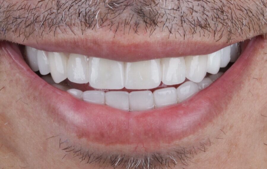 Volledige smile-makeover met facings — voor