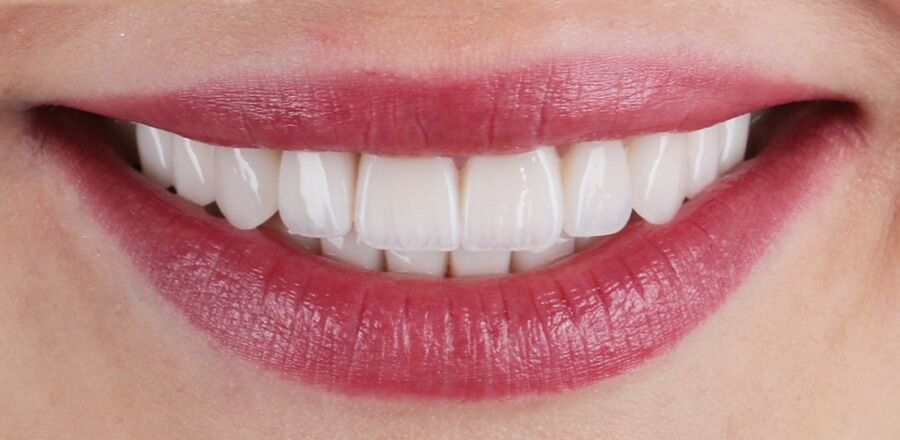 Smile-makeover met facings — na