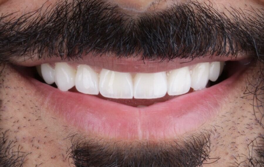 Smile-transformatie met porseleinen facings — na