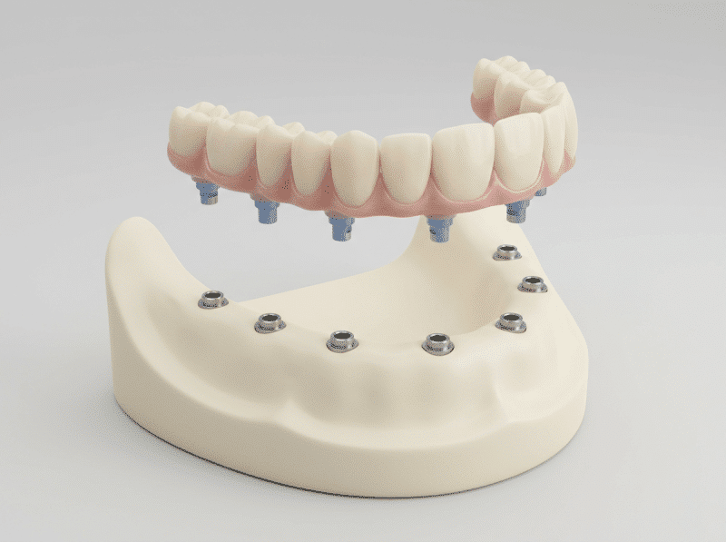 AI-illustratie met een eenvoudig anatomisch of keuzemodel voor all-on-6 tandheelkundige implantaten.