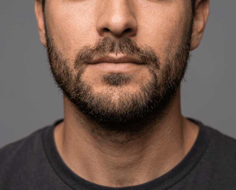AI-illustratie bij baard transplantatie: een natuurlijk, zelfstandig uitstralings- of dagelijks-levenconcept.