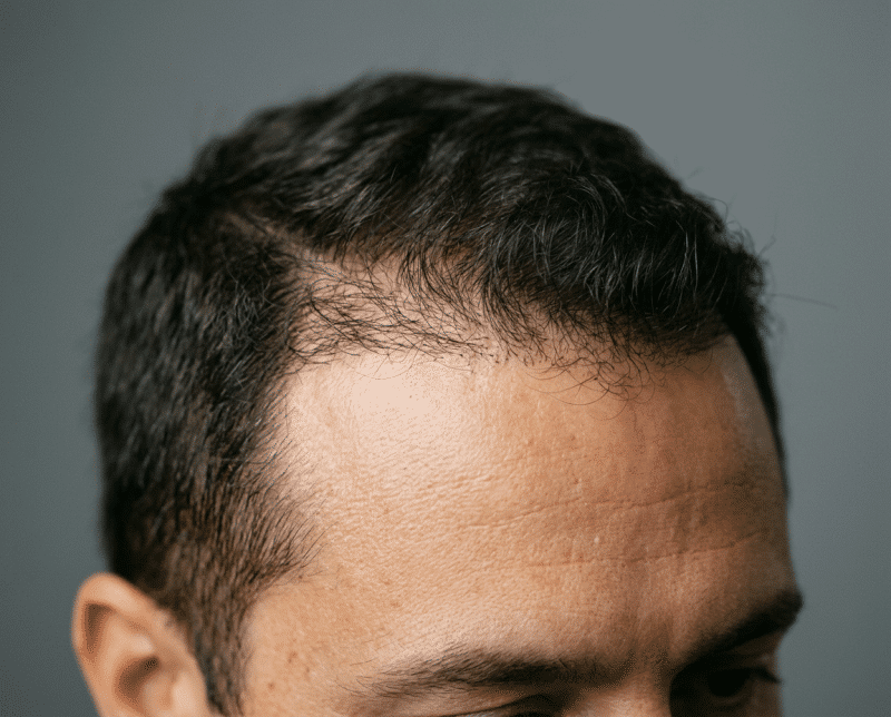 AI-illustratie bij dhi - directe haarimplantatie: een natuurlijk, zelfstandig uitstralings- of dagelijks-levenconcept.