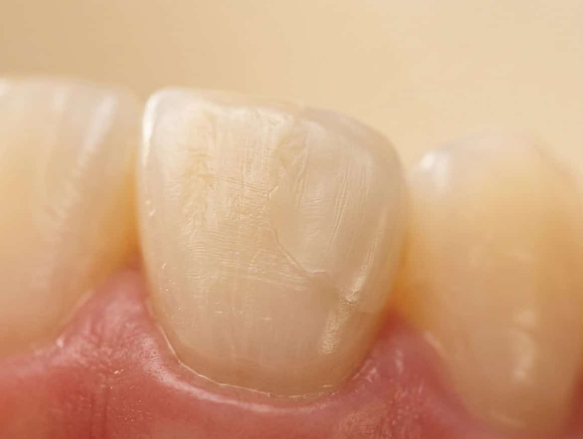Witte vulling behandeling
